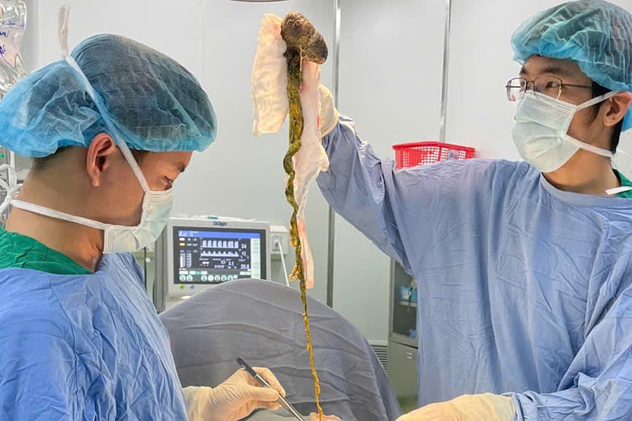 Hai giờ phẫu thuật lấy búi tóc khổng lồ khỏi dạ dày bé trai