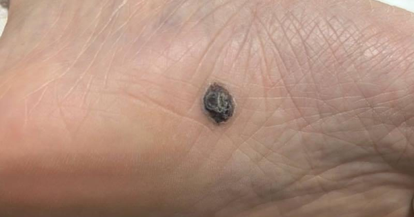 5 dấu hiệu nốt ruồi có thể là ung thư da, dấu hiệu số 1 dễ bị bỏ qua