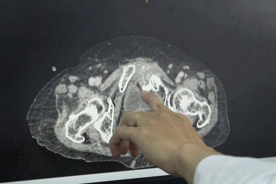 Cứu sống cụ bà bị vỡ bàng quang trong phúc mạc tự phát hiếm gặp