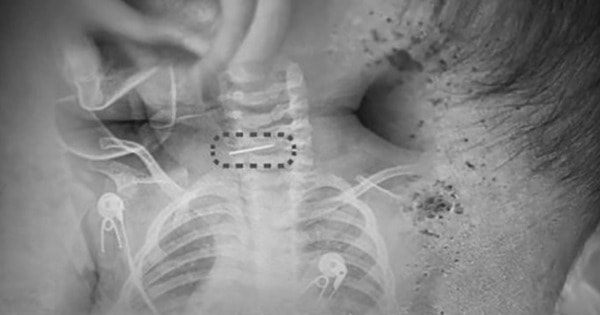 Bé trai bị sốt và co giật, bác sĩ phát hiện ra điều đáng sợ