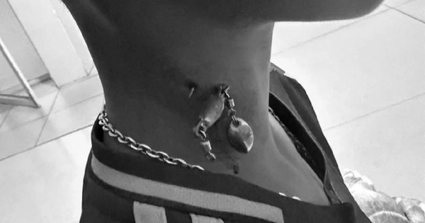 Bé trai 13 tuổi chảy máu nhiều, bác sĩ sốc khi phát hiện bí mật "đáng sợ" ở cổ