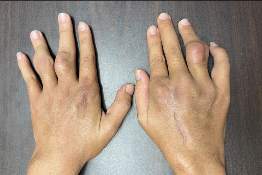 Bí quyết kiểm soát bệnh gout dịp Tết