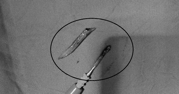 Người đàn ông 41 tuổi đau bụng, bác sĩ sốc phát hiện ra thứ đáng sợ "đi lạc" trong bụng