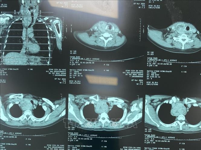 Chẩn đoán hình ảnh không cần phim in vào Quỹ BHYT chi trả