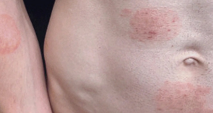 Nấm da lây truyền qua đường tình dục bùng phát tại Mỹ