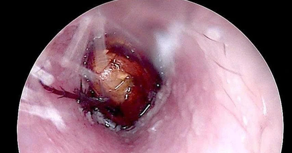 Cháu bé đau tai dữ dội, bác sĩ sốc ngang phát hiện bí mật "đáng sợ" bên trong