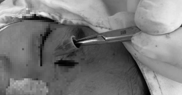 Bé trai đau vùng mắt dữ dội, bác sĩ sốc khi phát hiện dị vật "tàng hình"