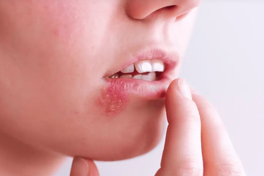 Người phụ nữ 30 tuổi chết não vì chủ quan với mụn rộp khóe miệng