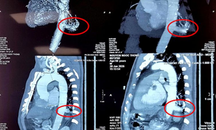Phần 'phổi thừa' hút máu động mạch chủ người đàn ông suốt 56 năm