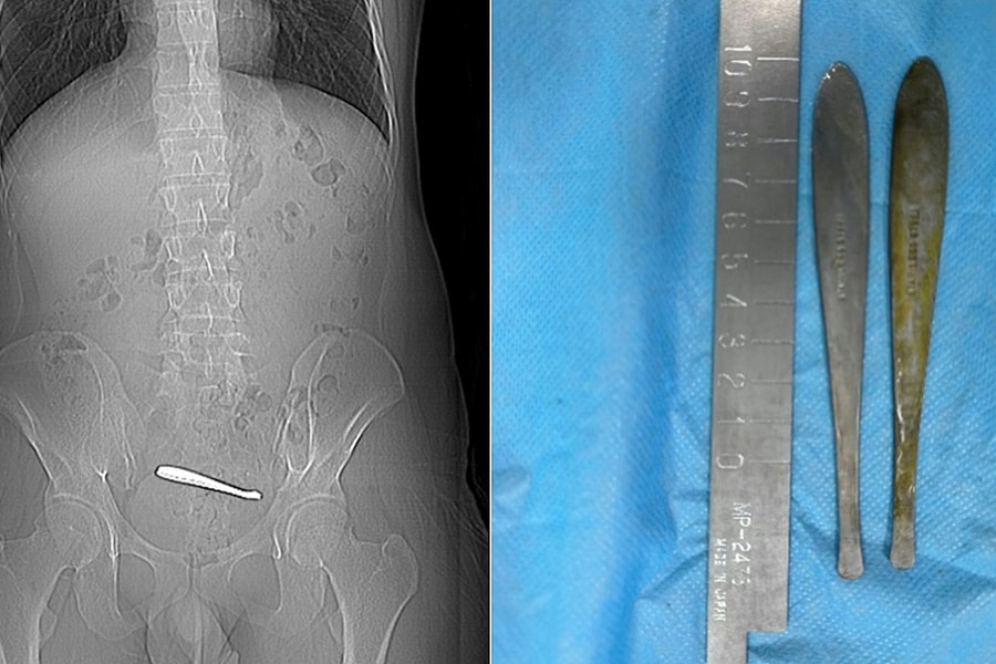 2 chiếc thìa 12 cm kẹt trong ruột chàng trai