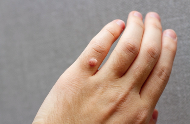 'Hạt cơm' - tổn thương nhỏ có thể lây lan to