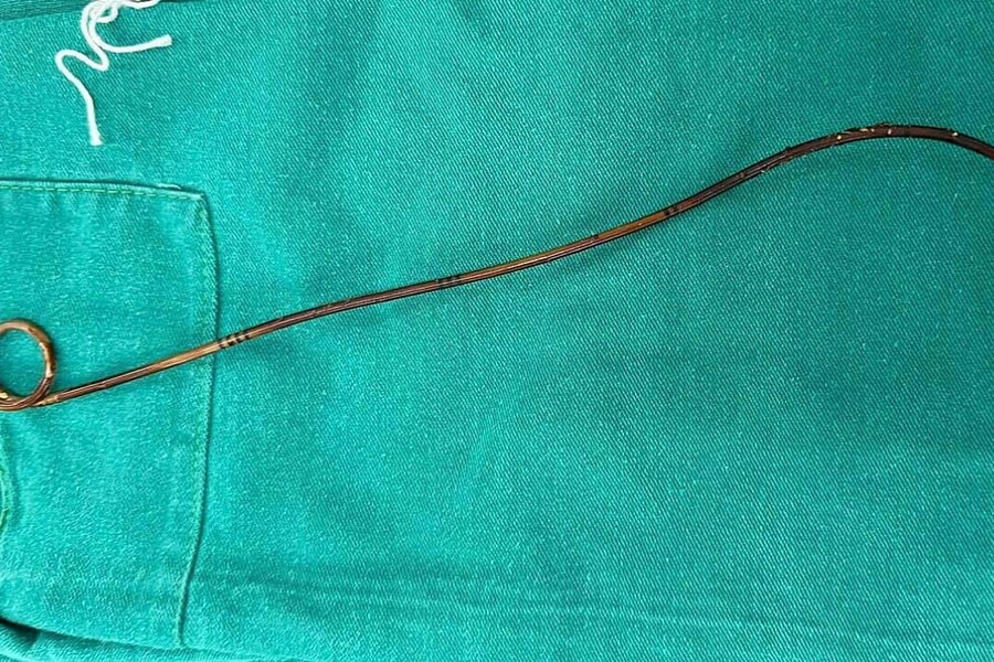 Ống thông bị bỏ quên trong cơ thể người đàn ông suốt hai năm