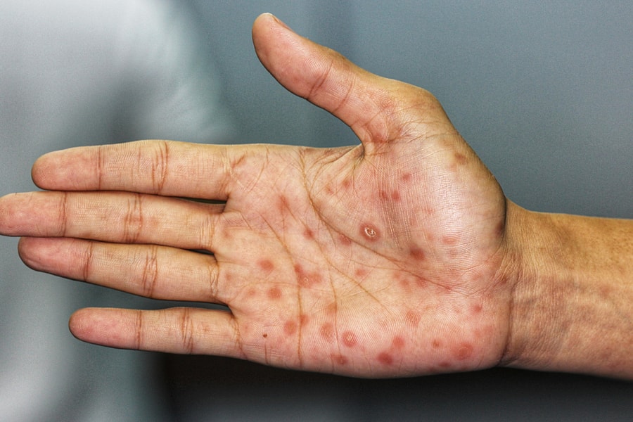 Phát hiện mắc giang mai từ nốt ban đỏ lòng bàn tay