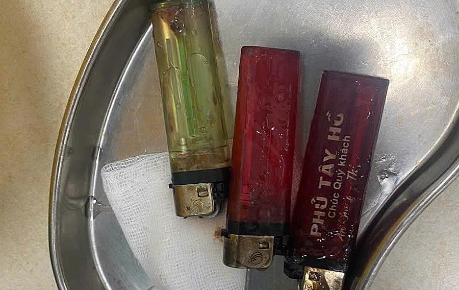 Gắp 3 chiếc bật lửa trong dạ dày người đàn ông