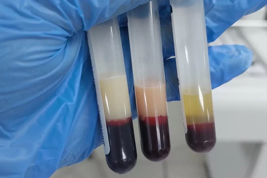 Huyết tương đục như sữa, viêm tụy hoại tử sau chuỗi ngày tiệc tùng