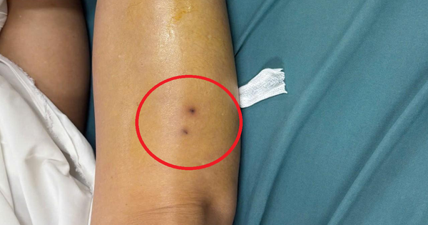 Suýt mất mạng vì rắn độc, người phụ nữ hồi phục thần kỳ sau 1 ngày điều trị