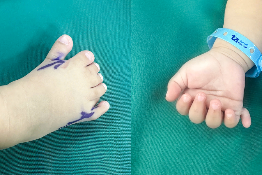 Bé gái có 26 ngón tay chân