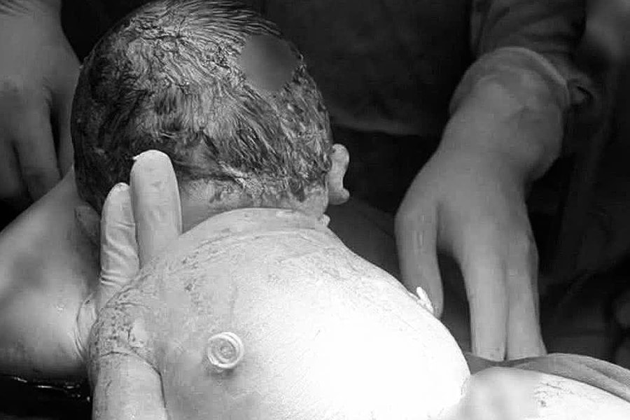 Em bé chào đời với 'đôi cánh nhỏ' trên lưng