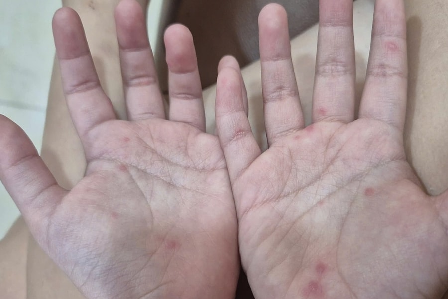 Dấu hiệu cảnh báo trẻ bệnh tay chân miệng trở nặng