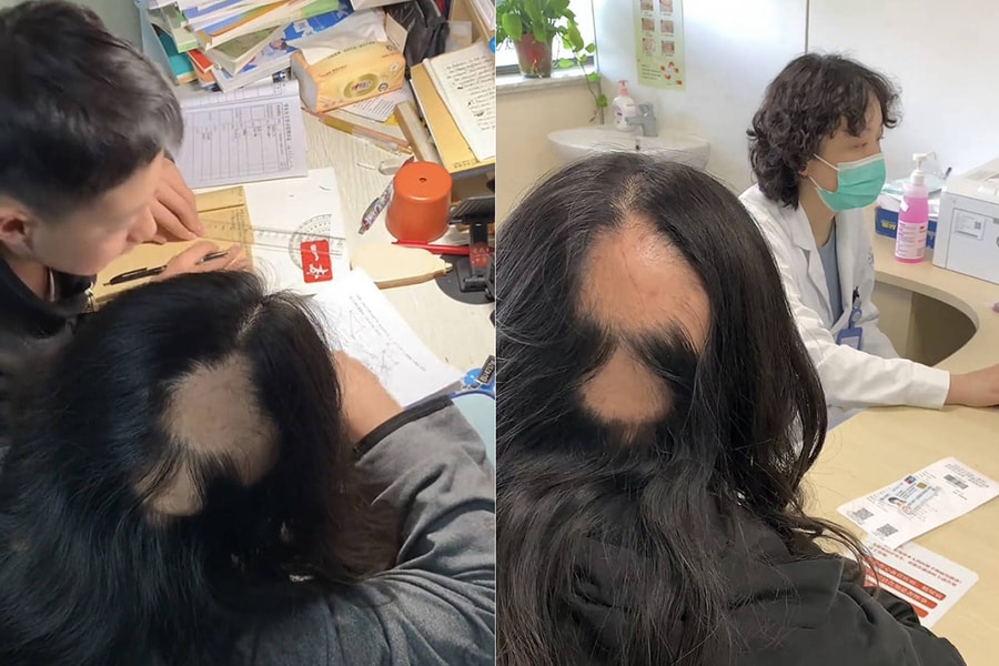 Mẹ hói cả mảng lớn vì thức đêm kèm con học