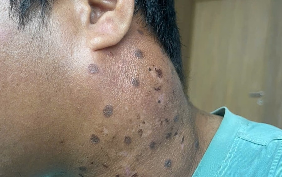 Tưởng cảm xoàng hóa ung thư giai đoạn cuối