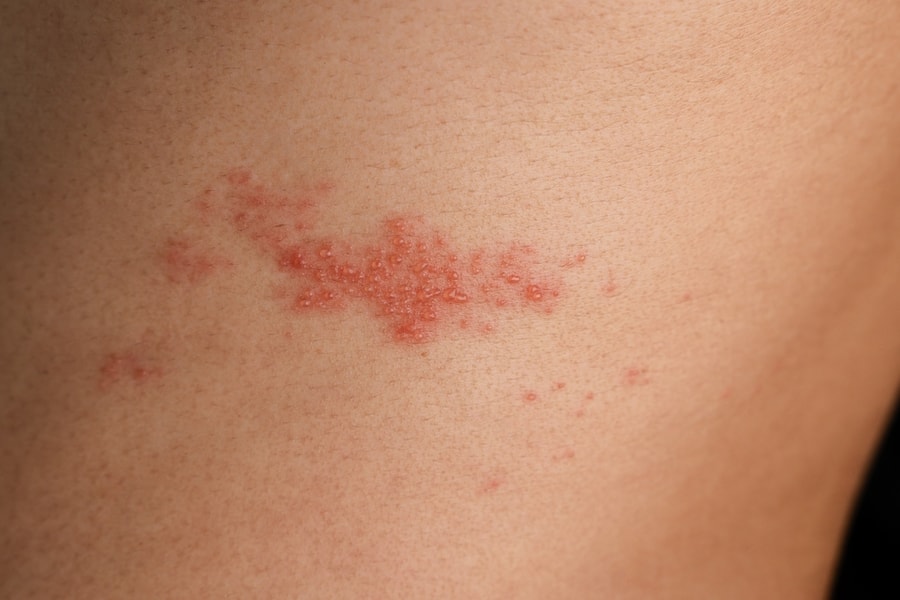 Đau nhức kéo dài vì zona thần kinh chuyển nặng