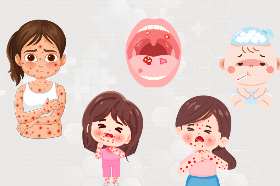 Phân biệt triệu chứng tay chân miệng với sốt mọc răng, dị ứng