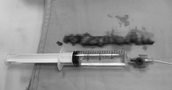 Đau lưng kéo dài tưởng xương khớp, người phụ nữ tá hỏa khi biết mình mắc bệnh nguy hiểm