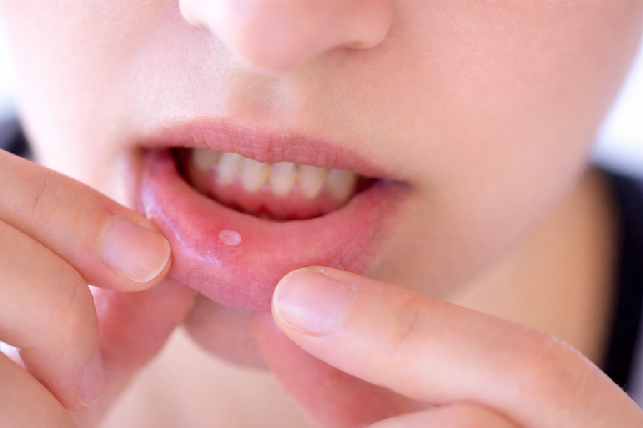 Dấu hiệu cảnh báo ung thư miệng không nên bỏ qua