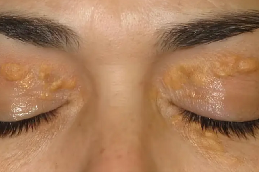 2 dấu hiệu trên mặt cảnh báo cholesterol xấu chạm ngưỡng nguy hiểm