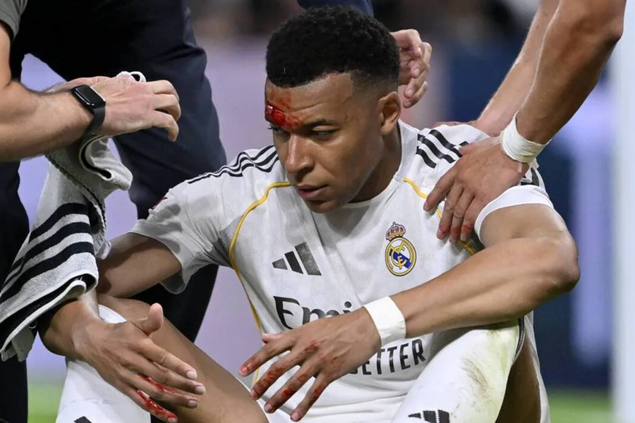 Mbappe khâu 3 mũi trên trán sau va chạm