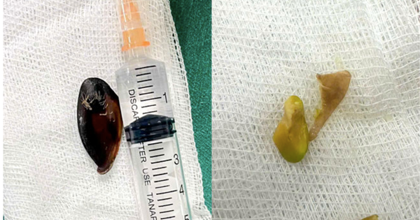 Bé 14 tuổi ho khan kéo dài, gia đình sốc khi bác sĩ lấy ra dị vật bên trong cơ thể