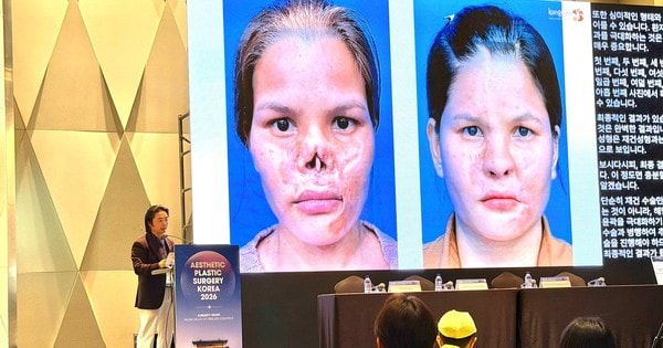 Giải pháp điều trị biến chứng sau nâng mũi gây chú ý tại Hội nghị thẩm mỹ quốc tế APS Korea 2026