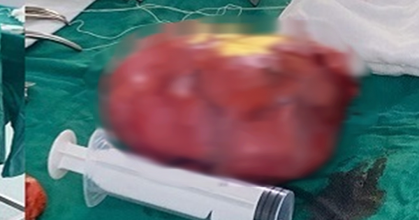 Đau bụng tưởng nhẹ, người phụ nữ sốc nặng khi bác sĩ lấy ra thứ “đáng sợ” trong bụng