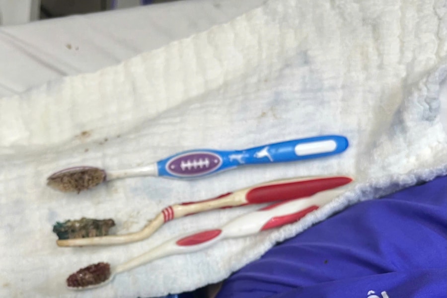 Gắp 3 bàn chải dài gần 20 cm khỏi dạ dày nam thanh niên